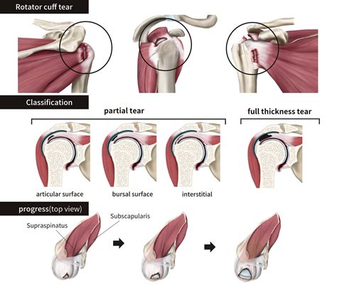 Rotator Cuff Syndrome Treatment | Progressive Sports Medicine Leichhardt | Sydney