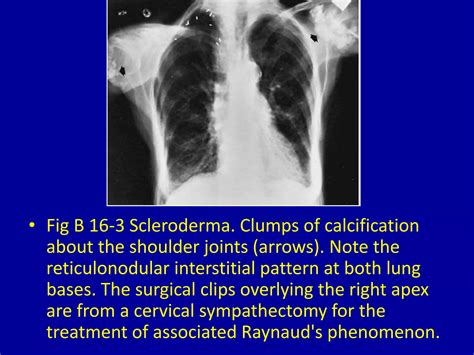 16 periarticular calcification | PPTX