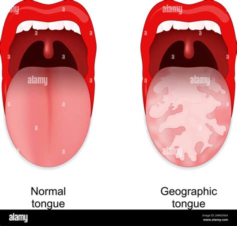 Megaloblastic Anemia Tongue