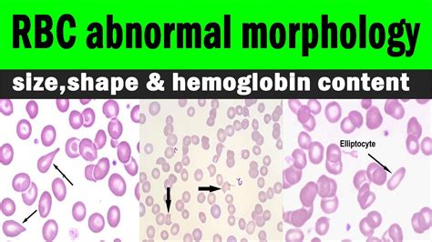 Red blood cells | RBC abnormal morphology | size,shape & hemoglobin content | Hematology : r/medical