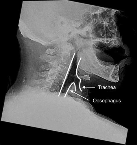 Soft Tissue Neck X Ray Anatomy