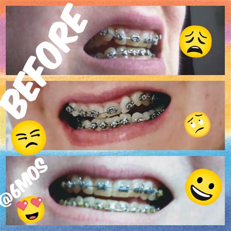 I Got Braces at 60 Years Old, and My Smile’s Never Looked Better HD Wallpaper