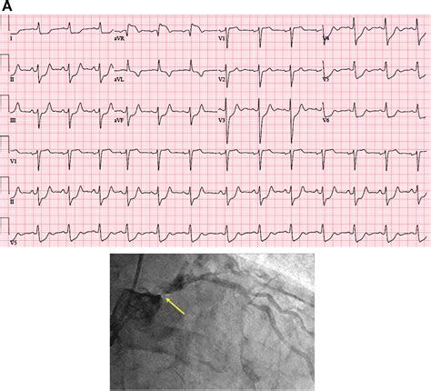 ECGs in Critical Care Cardiology: Do Not Miss That Myocardial ...
