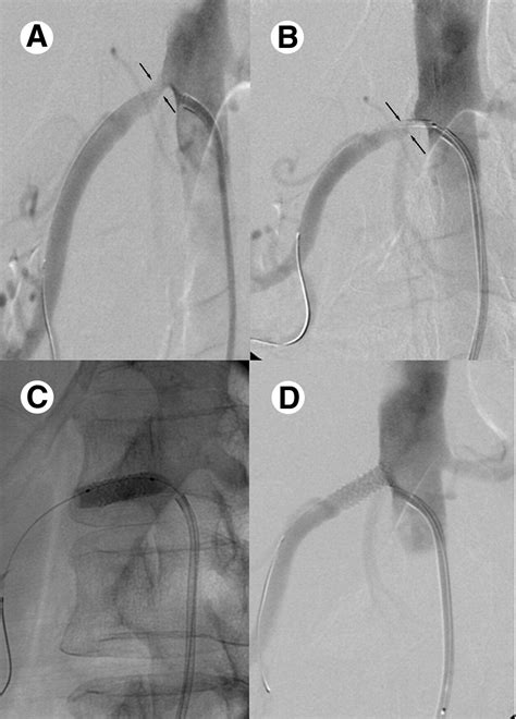 Renal Artery Stenting Guidelines at Denise Callaghan blog