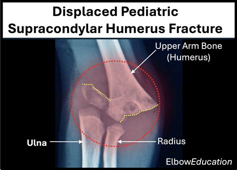 Pediatric Supracondylar Humerus Fracture - Elbow Education