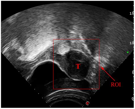 Automated Uterine Fibroids Detection in Ultrasound Images Using Deep ...