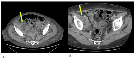 The Revolution of Immunotherapy in Gynecological Cancers: The Lazarus ...