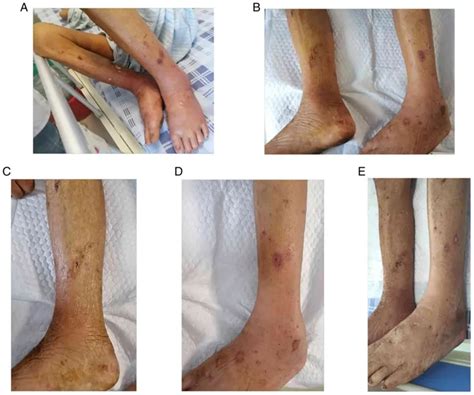 The rise of carbapenem - Resistant Klebsiella pneumoniae Infection
