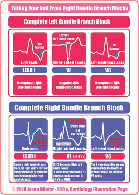 ECG Educator Blog : Bundle Branch Blocks