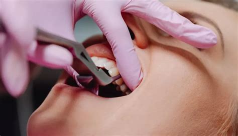 Image result for Tooth Root Extraction