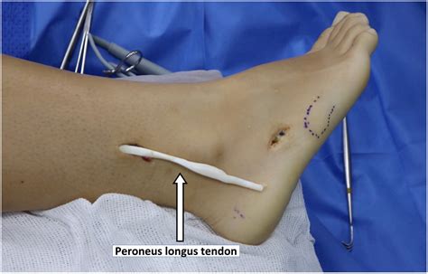 Combined Anterior Cruciate Ligament and Anterolateral Ligament Reconstruction Using a Single ...