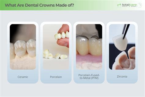 What Are Crowns Made Of