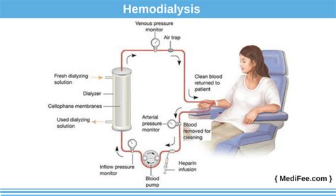 Image result for Dialysis Procedure Step by Step