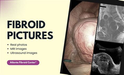 Uterus Fibroid Belly Pictures Calcified Uterine Fibroid Stock Image