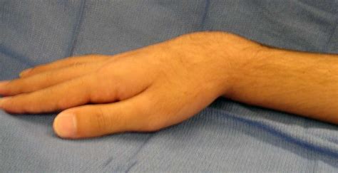 Image result for Distal Radius Fracture Recovery