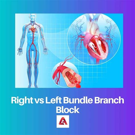Right vs Left Bundle Branch Block: Difference and Comparison