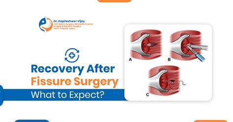 Navigating Recovery After Fissure Surgery: A Comprehensive Guide to Expectations and Healing
