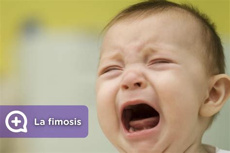 Fimosis, Qué Es, Causas, Síntomas Y Tratamientos – QNCJXH