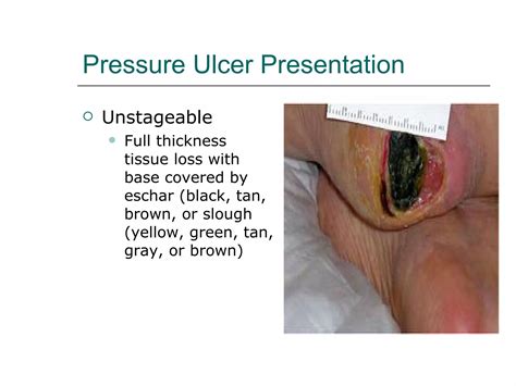 Pressure ulcer presentation3 | PPT