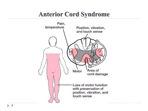 Presentaion - SCI Syndrome.pptx