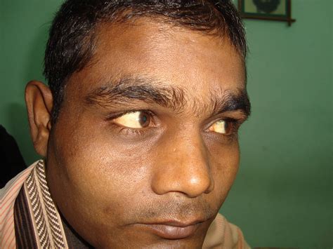 Jaundice In Black People: Signs and Detection