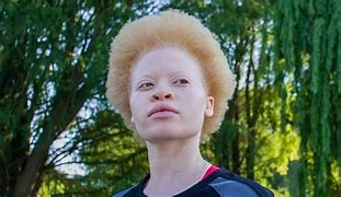 Image result for Natural Red Eyes Albino
