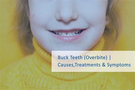 Buck Teeth (Overbite) | What are its Causes,Treatments & Symptoms | Wellness Dental Studio