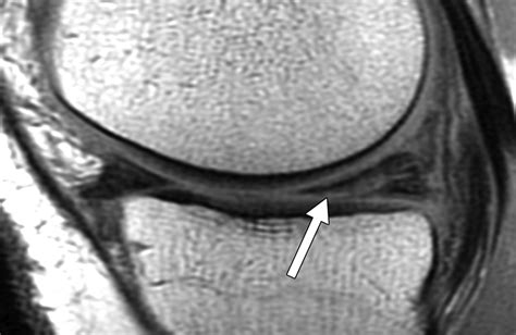Medial Meniscus Tear Mri
