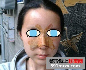 北京隆鼻术真人案例效果图_珍美网