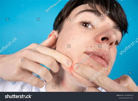 Image result for Exploding Pimples