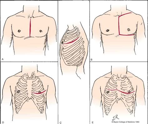 Image result for Open Chest Thoracotomy