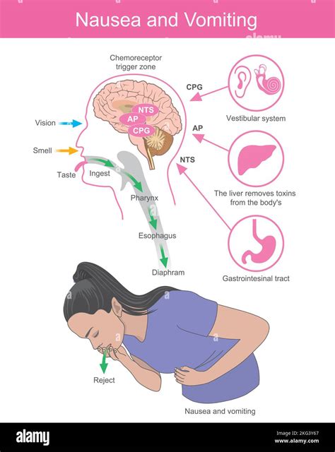 Nausea and Vomiting. A woman with symptoms the nausea and vomiting ...