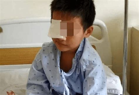 10岁男孩几近失明！医生强烈呼吁家长眼药水千万不要这样用了！_眼睛_药物_激素类