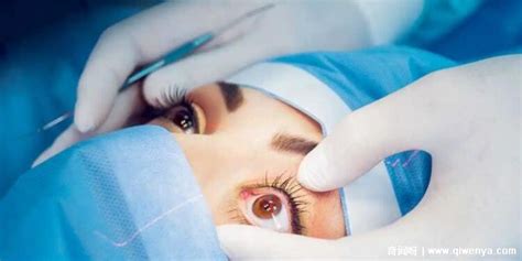 广州做近视眼矫正手术的收费是多少？近视眼手术价格一览表 - 哔哩哔哩