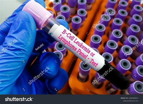 971 Tests Lymphoma Images, Stock Photos & Vectors | Shutterstock