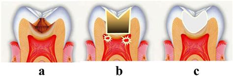 Protection and Reinforcement of Tooth Structures by Dental Coating ...