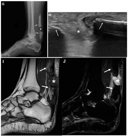 Extensive Ossification of the Achilles Tendon with and without Acute ...