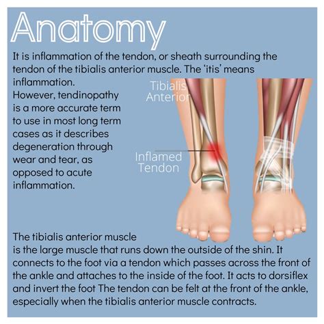 Tibialis Anterior Tendon Tear