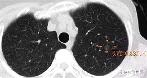 判断肺混合磨玻璃结节不是癌，这一点很重要