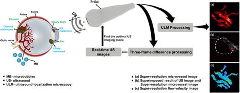Detecting Early Ocular Choroidal Melanoma Using Ultrasound Localization ...