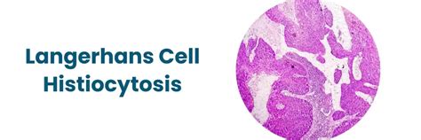 Langerhans Cell Histiocytosis: Symptoms, Causes, & Treatment