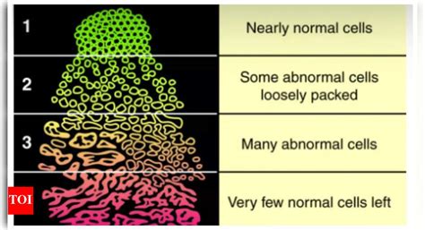 Prostate Cancer: What is the Gleason score in prostate Cancer and why ...