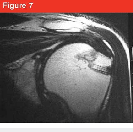 Image result for Single Row Rotator Cuff Repair