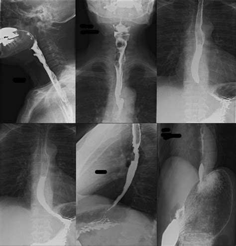 X-Ray Barium Swallow Procedure at Sophie Clarkson blog