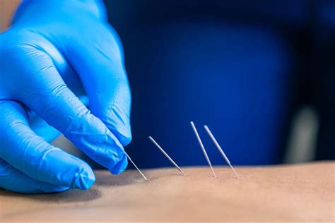 Understanding Dry Needling: A Key Tool in Physical Therapy
