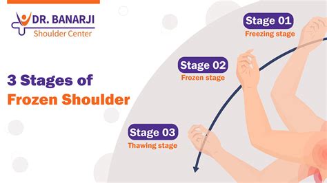 Frozen Shoulder