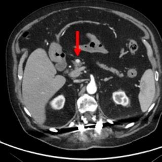 Image result for CT Scan with Contrast