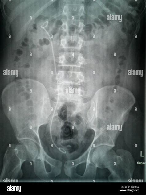 Kidney stones hi-res stock photography and images - Alamy