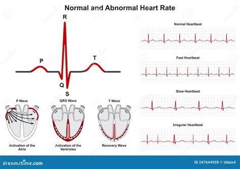Image result for Normal vs Abnormal ECG