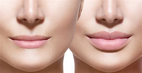 Image result for Restylane Refine